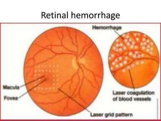 Retinal hemorrhage
 