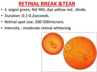 RETINAL BREAK &TEAR
• λ :argon green, Nd YAG, dye yellow red , diode.
• Duration :0.1-0.2seconds.
• Retinal spot size: 200-500microns.
• Intensity : moderate retinal whitening
 