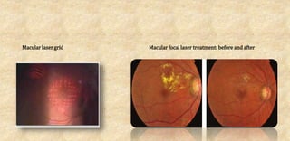 Macular laser grid Macular focal laser treatment: before and after
 