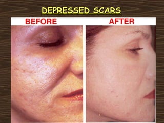 DEPRESSED SCARS
 