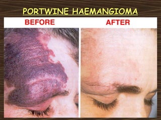 PORTWINE HAEMANGIOMA
 