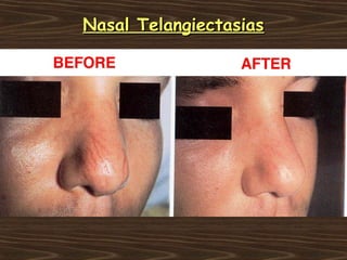 Nasal Telangiectasias
 