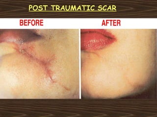 POST TRAUMATIC SCAR
 