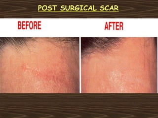 POST SURGICAL SCAR
 