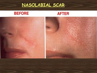 NASOLABIAL SCAR
 