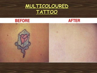 MULTICOLOURED
   TATTOO
 
