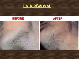 HAIR REMOVAL
 