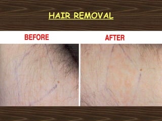 HAIR REMOVAL
 