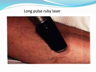 Long pulse ruby laser
 