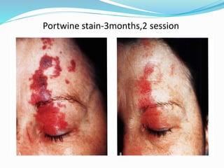 Portwine stain-3months,2 session
 