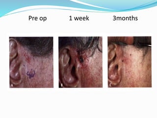 Pre op 1 week 3months
 