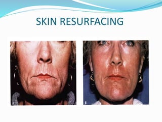 SKIN RESURFACING
 