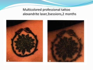 Multicolored professional tattoo
alexandrite laser,3sessions,2 months
 