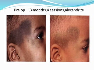 Pre op 3 months,4 sessions,alexandrite
 