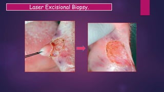 Laser Excisional Biopsy.
 