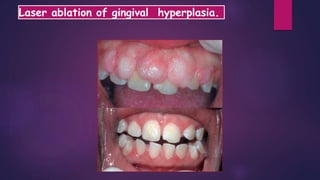 Laser ablation of gingival hyperplasia.
 