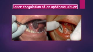Laser coagulation of an aphthous ulcuer
 
