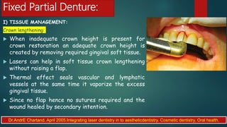 Fixed Partial Denture:
I) TISSUE MANAGEMENT:
Crown lengthening:
 When inadequate crown height is present for
crown restoration an adequate crown height is
created by removing required gingival soft tissue.
 Lasers can help in soft tissue crown lengthening
without raising a flap.
 Thermal effect seals vascular and lymphatic
vessels at the same time it vaporize the excess
gingival tissue.
 Since no flap hence no sutures required and the
wound healed by secondary intention.
Dr.AndrE Chartand. April 2005.Integrating laser dentistry in to aestheticdentistry. Cosmetic dentistry, Oral health.
 