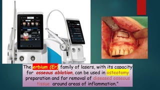 The erbium (Er) family of lasers, with its capacity
for osseous ablation, can be used in osteotomy
preparation and for removal of diseased osseous
tissue around areas of inflammation."
 