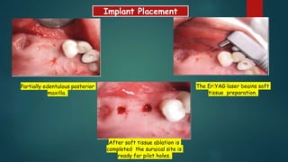 Implant Placement
Partially edentulous posterior
maxilla.
The Er:YAG laser begins soft
tissue preparation.
After soft tissue ablation is
completed the surgical site is
ready for pilot holes.
 