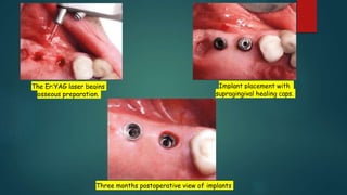 The Er:YAG laser begins
osseous preparation.
Implant placement with
supragingival healing caps.
Three months postoperative view of implants
 