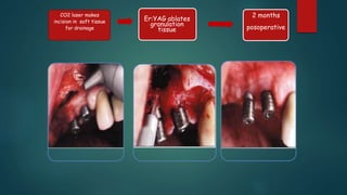 CO2 laser makes
incision in soft tissue
for drainage
Er:YAG ablates
granulation
tissue
2 months
posoperative
 