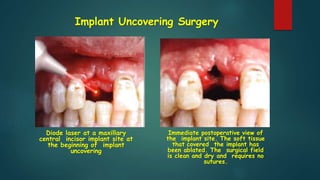 Implant Uncovering Surgery
Diode laser at a maxillary
central incisor implant site at
the beginning of implant
uncovering
Immediate postoperative view of
the implant site. The soft tissue
that covered the implant has
been ablated. The surgical field
is clean and dry and requires no
sutures.
 