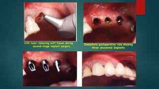 CO2 laser removing soft tissue during
second-stage implant surgery.
Immediate postoperative view showing
three uncovered Implants
 