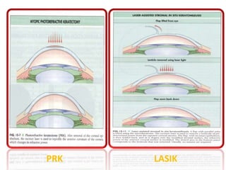PRK LASIK
 