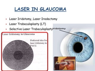 LASER IN GLAUCOMA
 Laser Iridotomy, Laser Iredectomy
 Laser Trabeculoplasty (LT)
 Selective Laser Trabeculoplasty
 
