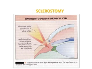 SCLEROSTOMY
 