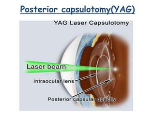Posterior capsulotomy(YAG)
 