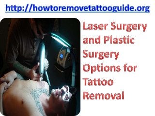 Laser surgery and plastic surgery options for tattoo removal