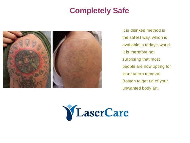 Laser Tattoo removal