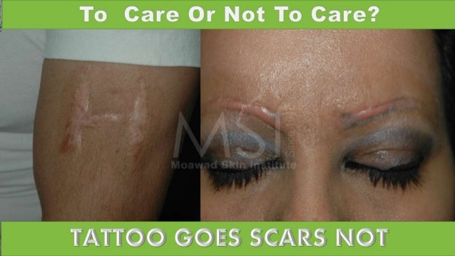 laser tattoo removal the savior laser tattoo removal the savior