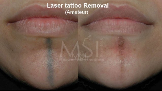 laser tattoo removal the savior laser tattoo removal the savior