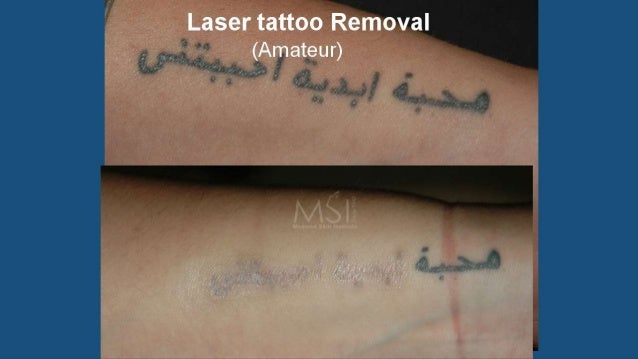 laser tattoo removal the savior laser tattoo removal the savior