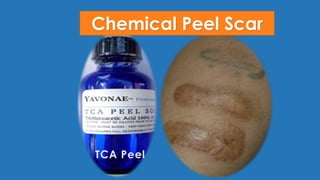 Chemical Peel Scar
 