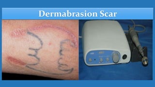 Dermabrasion Scar
 