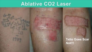 Tatto Goes Scar
Not!!!
 