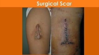 Surgical Scar
 