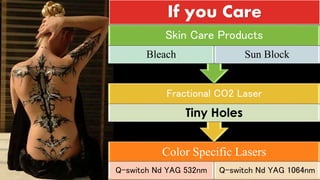 Color Specific Lasers
Q-switch Nd YAG 532nm Q-switch Nd YAG 1064nm
Fractional CO2 Laser
Tiny Holes
Skin Care Products
Bleach Sun Block
If you Care
 