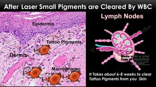 Epidermis
Dermis
Tattoo Pigments
Macrophages
It Takes about 6-8 weeks to clear
Tattoo Pigments from you Skin
After Laser Small Pigments are Cleared By WBC
 