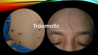 Traumatic
 