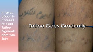 It Takes
about 6-
8 weeks
to clear
Tattoo
Pigments
from you
Skin
 