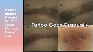 It Takes
about 6-
8 weeks
to clear
Tattoo
Pigments
from you
Skin
 
