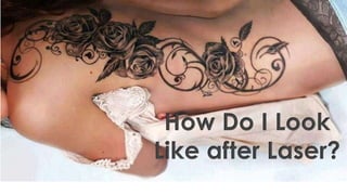 How Do I Look
Like after Laser?
 