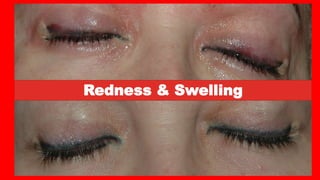 Redness & Swelling
 