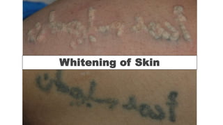 Whitening of Skin
 