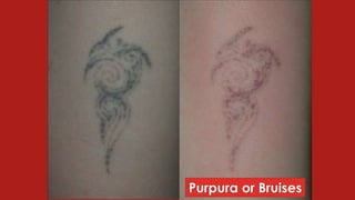 Purpura or Bruises
 